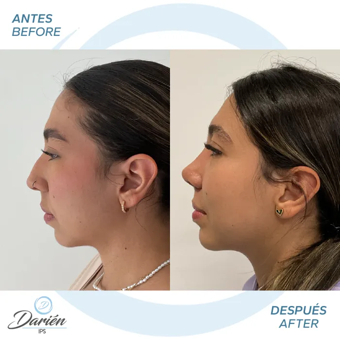 resultado rinoplastia medellin