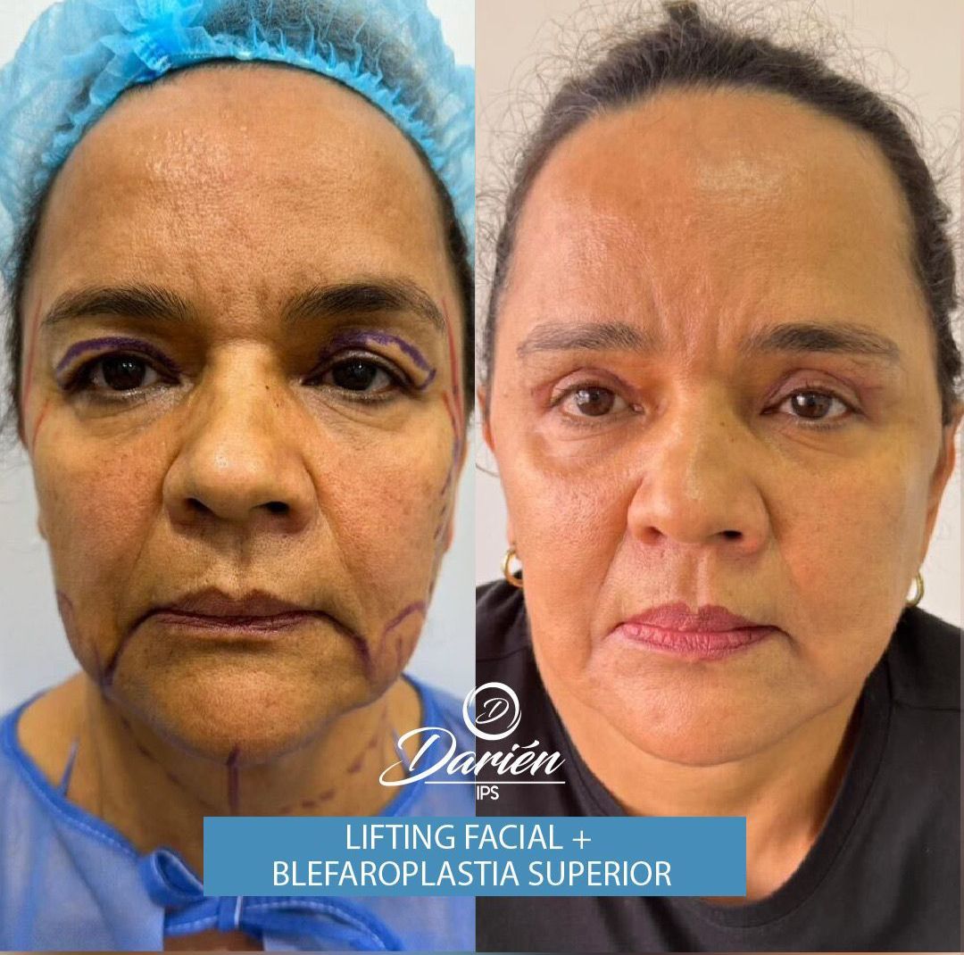 lifting Facial 1