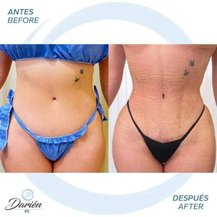 antes y despues de lipomarcacion